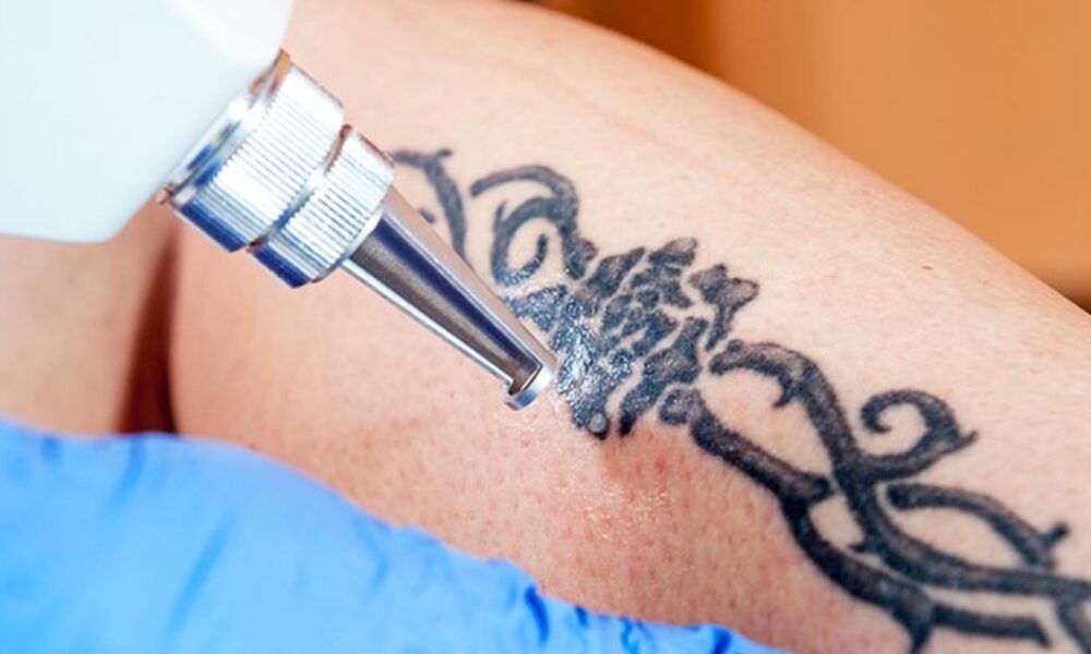 Tattoo Removal Timeline