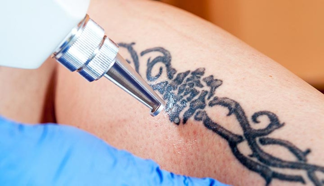 Tattoo Removal Timeline